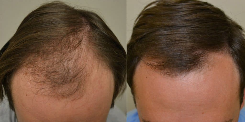 What is Finasteride Treatment?